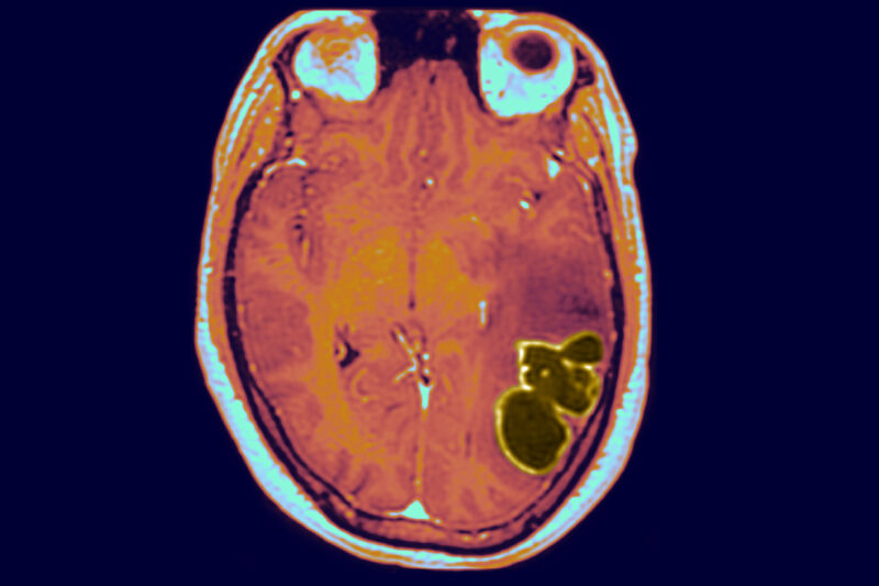 An MRI image of a brain with an abscess causing seizures. 